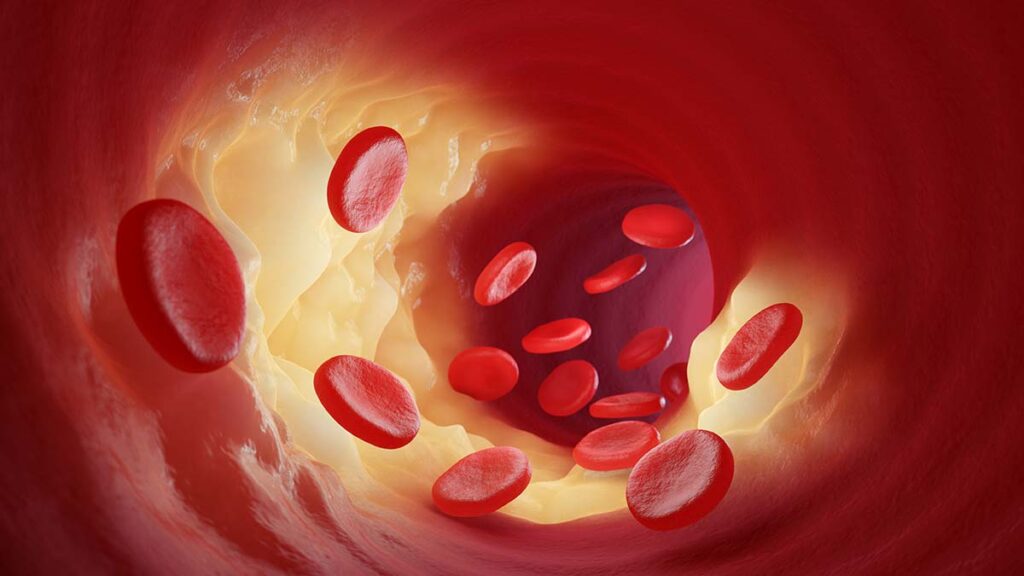 ไขมันในเลือดสูง (Dyslipidemia)