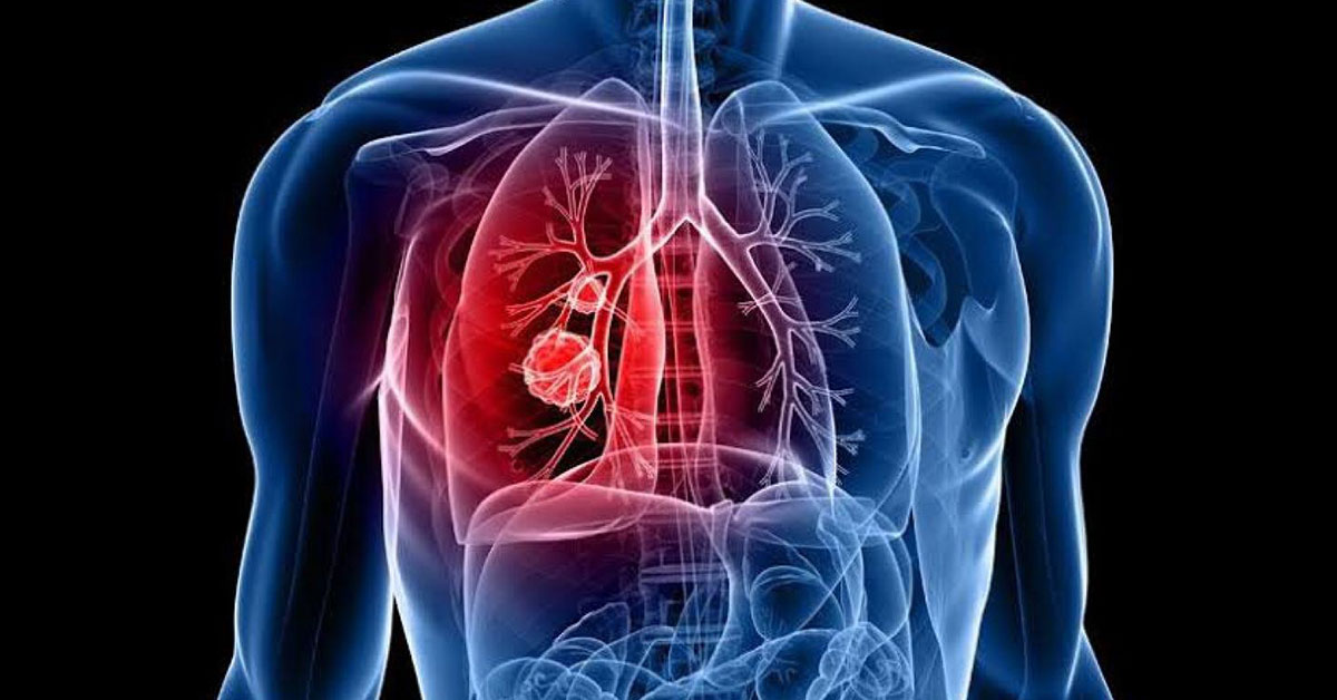โรคมะเร็งปอด (Lung Cancer)
