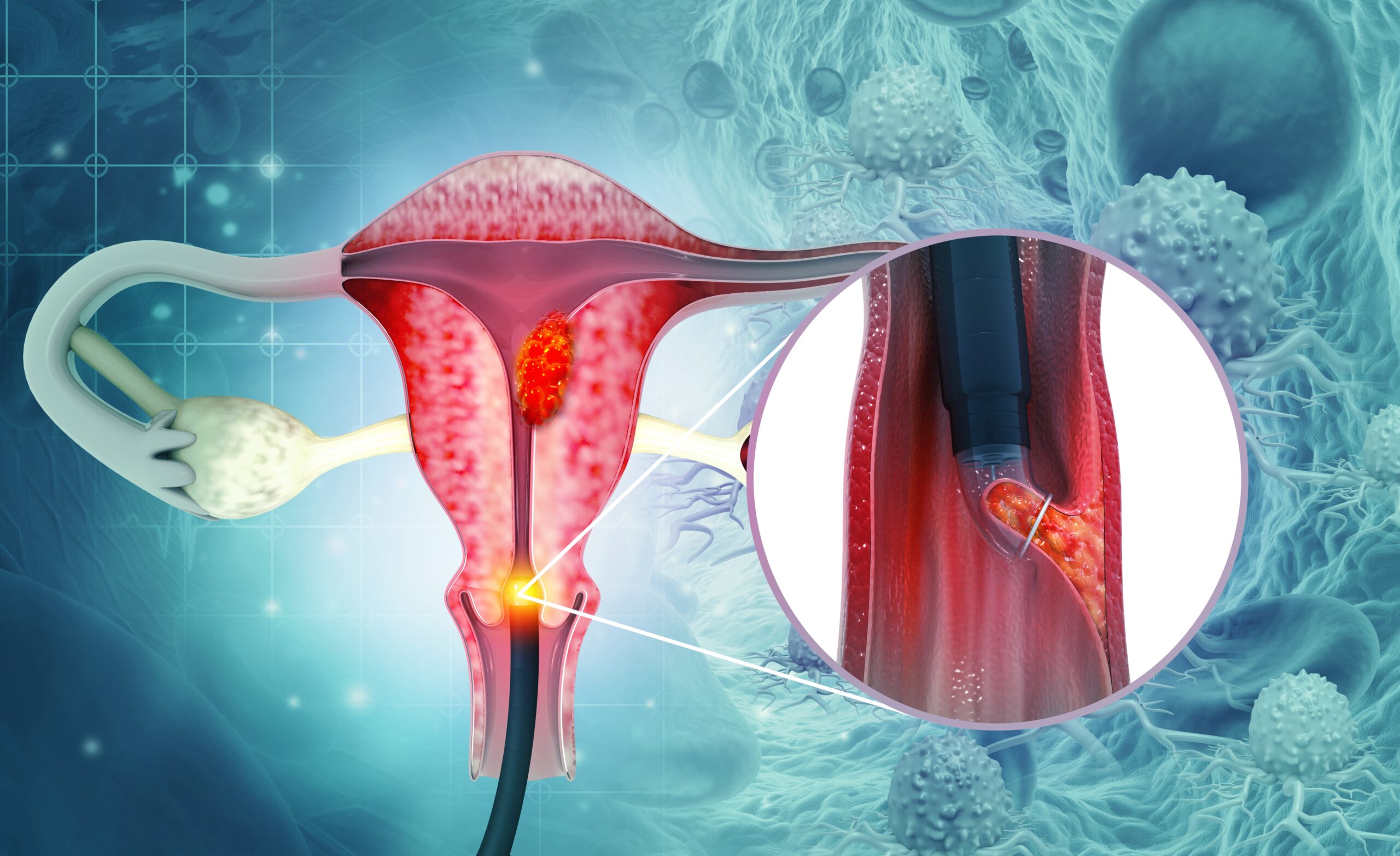 โรคมะเร็งปากมดลูก (Cervical Cancer)