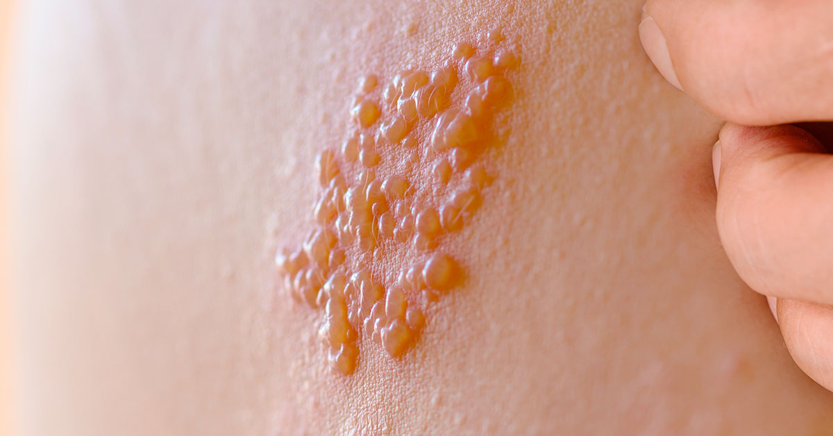 โรคงูสวัด (Herpes Zoster)